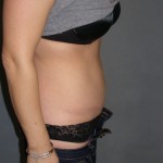 Tummy Tuck Before & After Patient #4023