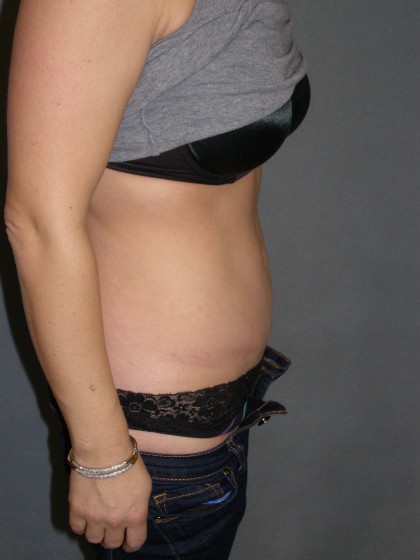 Tummy Tuck Before & After Patient #4023