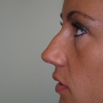 Rhinoplasty Before & After Patient #4146