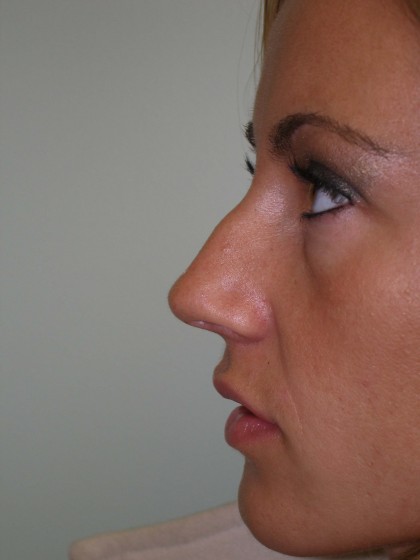 Rhinoplasty Before & After Patient #4146