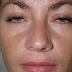 Rhinoplasty Before & After Patient #4146