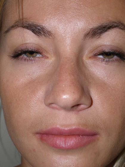 Rhinoplasty Before & After Patient #4146