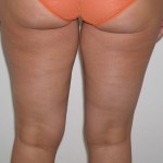 Liposuction Before & After Patient #3960