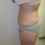 Tummy Tuck Before & After Patient #4030