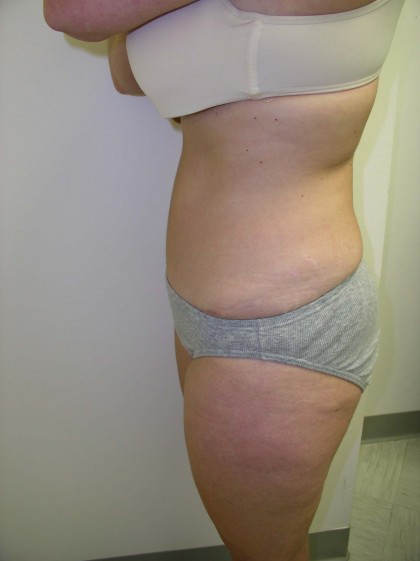 Tummy Tuck Before & After Patient #4030