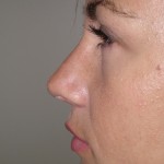 Rhinoplasty Before & After Patient #4146
