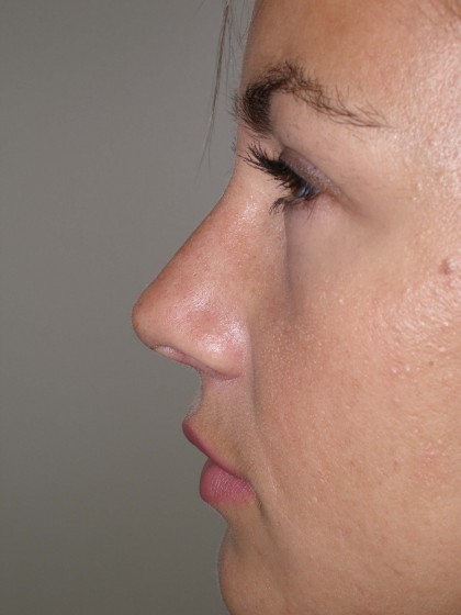 Rhinoplasty Before & After Patient #4146