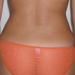 Liposuction Before & After Patient #3960