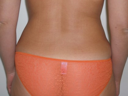 Liposuction Before & After Patient #3960