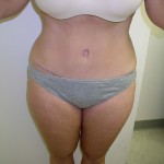 Tummy Tuck Before & After Patient #4030