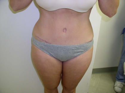 Tummy Tuck Before & After Patient #4030