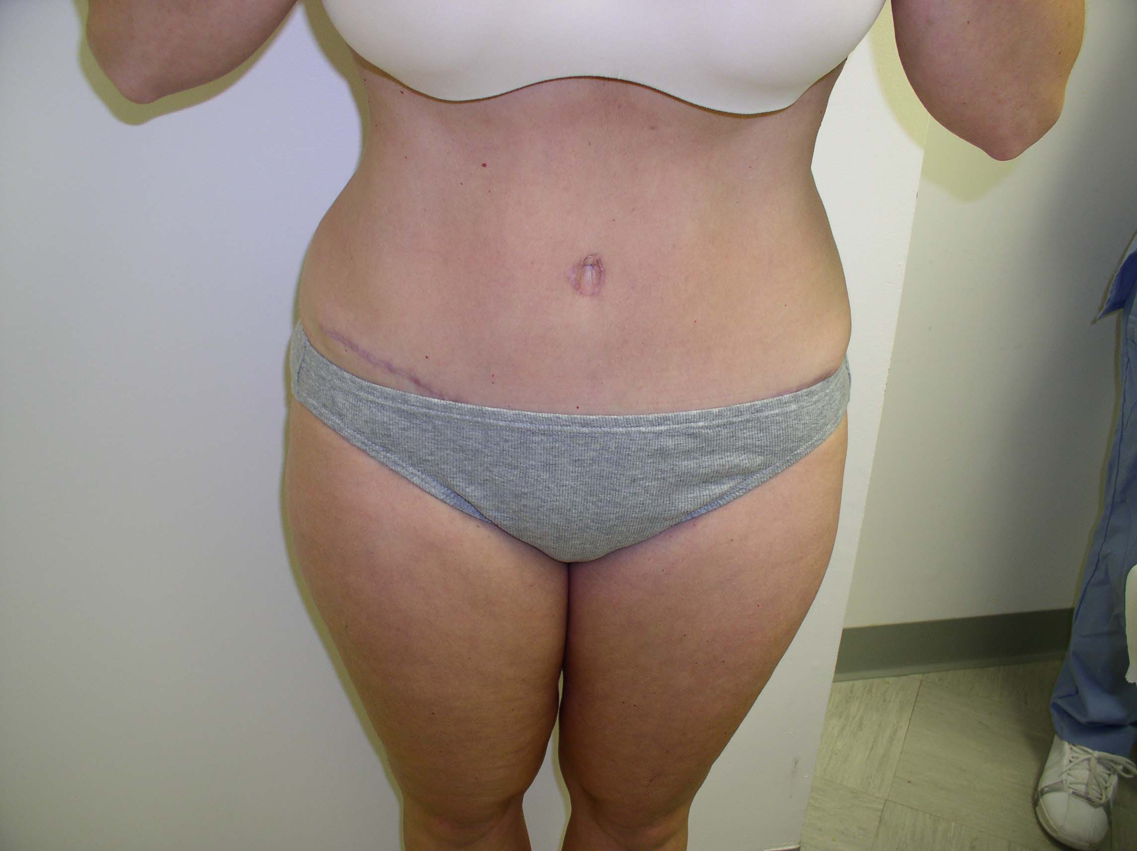 Tummy Tuck Before & After Patient #4030