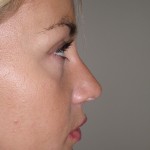 Rhinoplasty Before & After Patient #4146