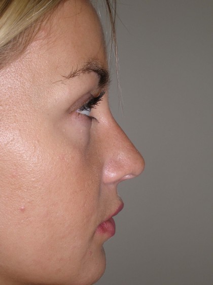 Rhinoplasty Before & After Patient #4146