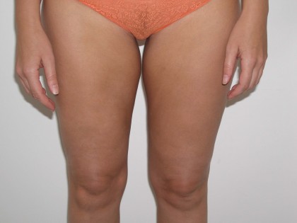 Liposuction Before & After Patient #3960