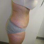 Tummy Tuck Before & After Patient #4030