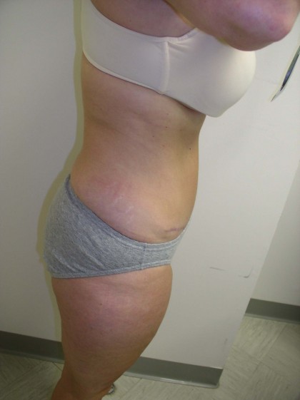 Tummy Tuck Before & After Patient #4030