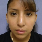 Rhinoplasty Before & After Patient #4165