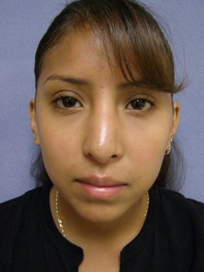 Rhinoplasty Before & After Patient #4165
