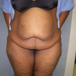 Tummy Tuck Before & After Patient #4037