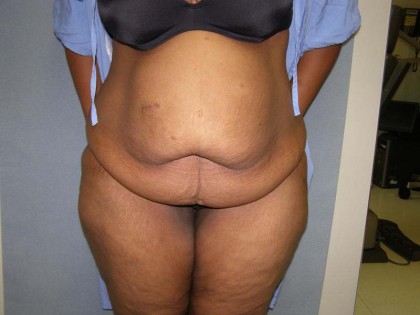 Tummy Tuck Before & After Patient #4037