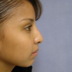 Rhinoplasty Before & After Patient #4165