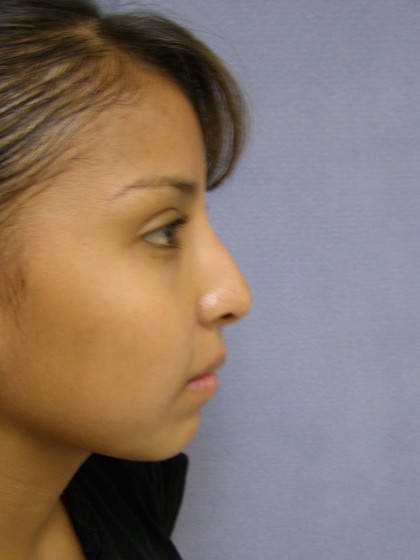 Rhinoplasty Before & After Patient #4165