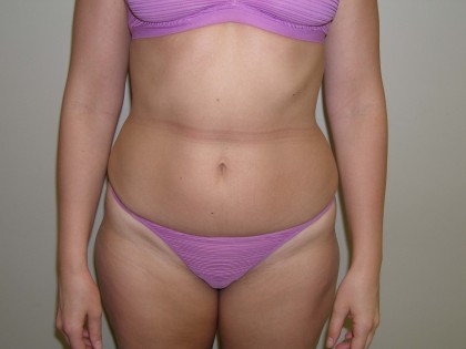 Liposuction Before & After Patient #3960