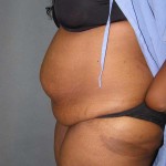 Tummy Tuck Before & After Patient #4037