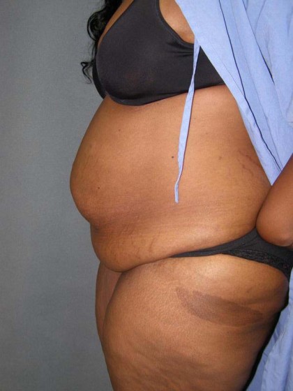 Tummy Tuck Before & After Patient #4037