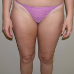 Liposuction Before & After Patient #3960