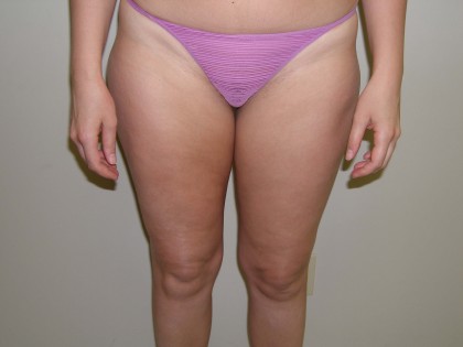 Liposuction Before & After Patient #3960