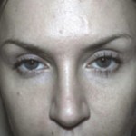 Eyelid Surgery Before & After Patient #4678