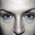 Eyelid Surgery Before & After Patient #4678