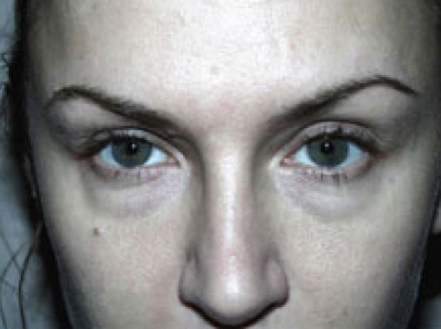 Eyelid Surgery Before & After Patient #4678