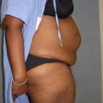 Tummy Tuck Before & After Patient #4037