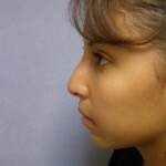 Rhinoplasty Before & After Patient #4165