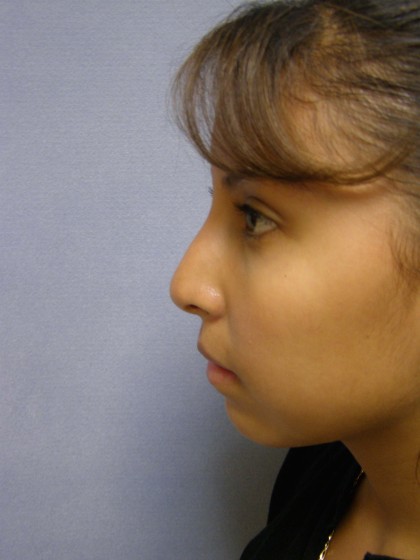 Rhinoplasty Before & After Patient #4165
