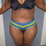 Tummy Tuck Before & After Patient #4037