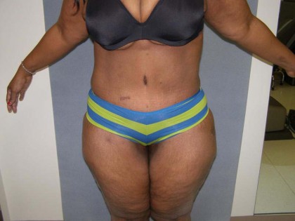 Tummy Tuck Before & After Patient #4037