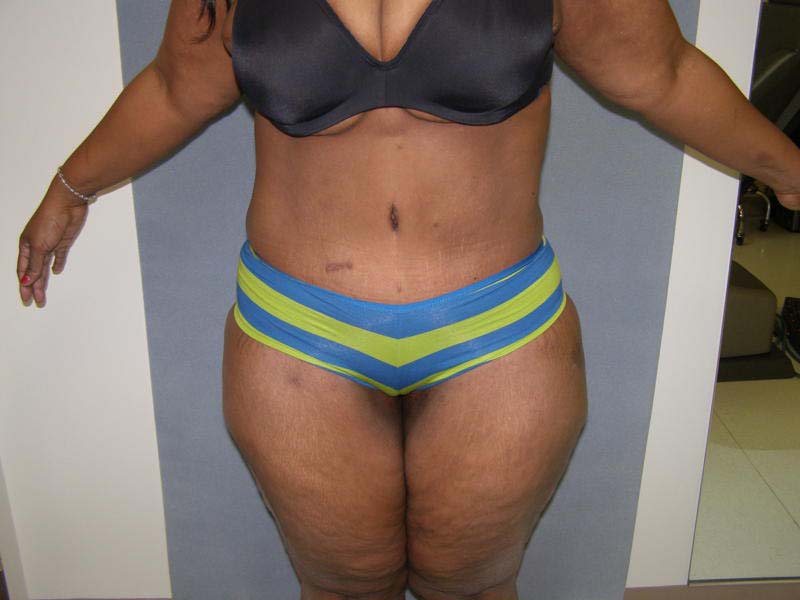 Tummy Tuck Before & After Patient #4037