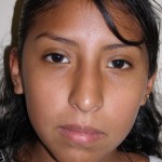 Rhinoplasty Before & After Patient #4165