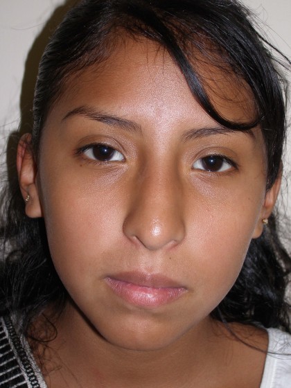 Rhinoplasty Before & After Patient #4165