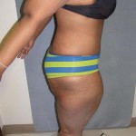 Tummy Tuck Before & After Patient #4037