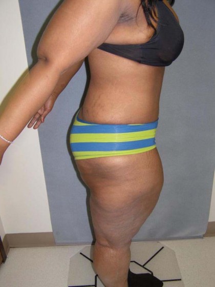 Tummy Tuck Before & After Patient #4037