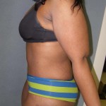 Tummy Tuck Before & After Patient #4037