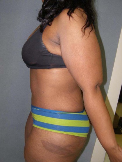 Tummy Tuck Before & After Patient #4037