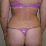Liposuction Before & After Patient #3960