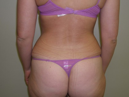 Liposuction Before & After Patient #3960