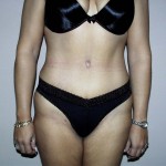 Tummy Tuck Before & After Patient #4044